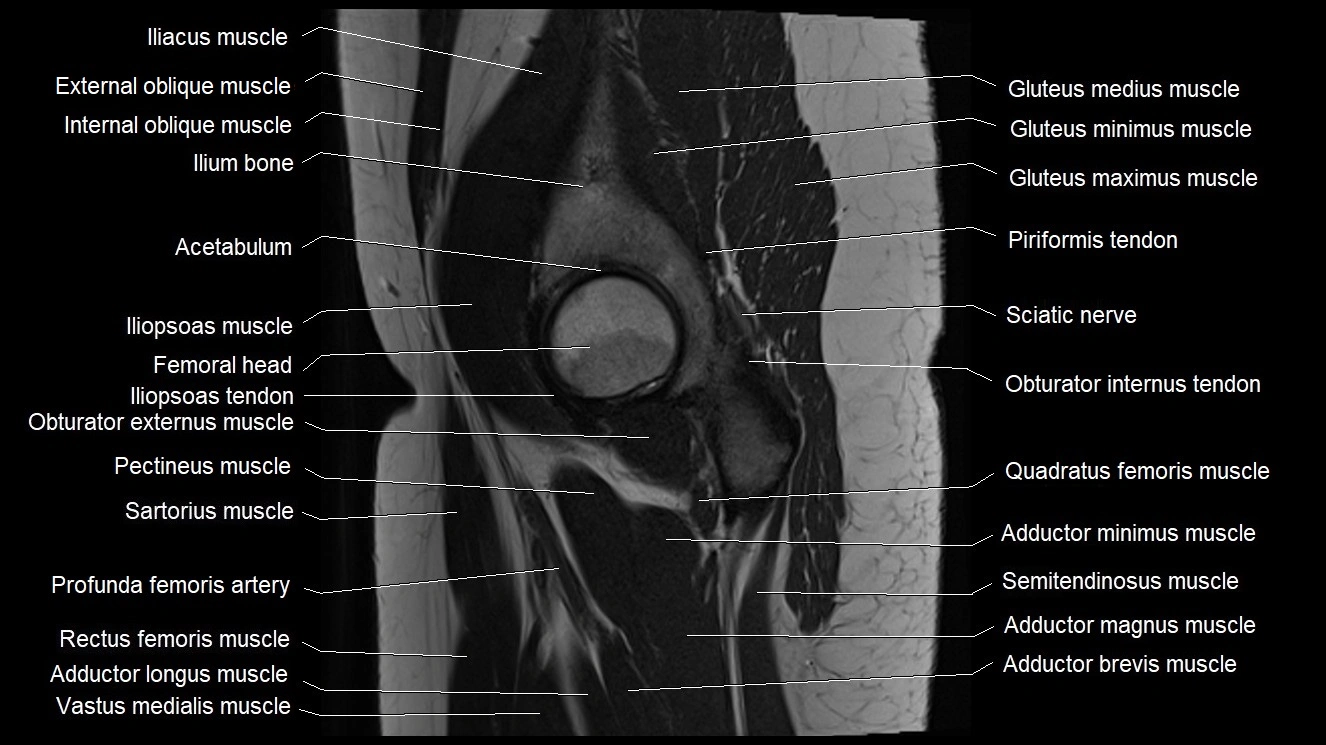 Hip sagittal cross sectional anatomy image 20.webp